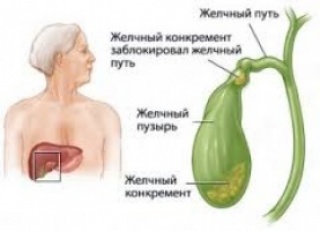 Что такое холецистит. Причины и симптомы холецистита (камней в желчном пузыре)