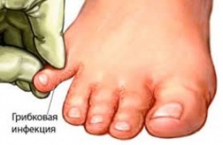 Грибок: откуда берется и что делать